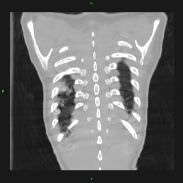 File:Cannon ball metastases - synovial sarcoma (Radiopaedia 26135-26271 Coronal lung window 21).jpg
