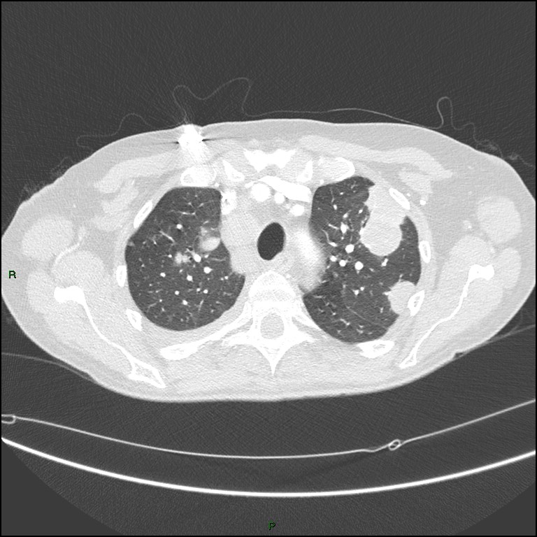 Cannonball metastases (Radiopaedia 82110-96150 Axial lung window 54).jpg