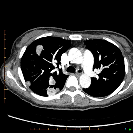 Canonball lung metastasis (Radiopaedia 77634-89837 B 34).jpg