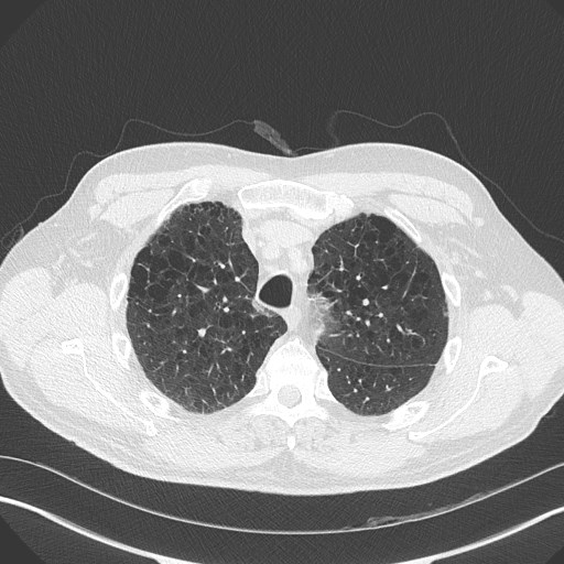 Caplan syndrome (Radiopaedia 56667-63530 Axial lung window 55).jpg