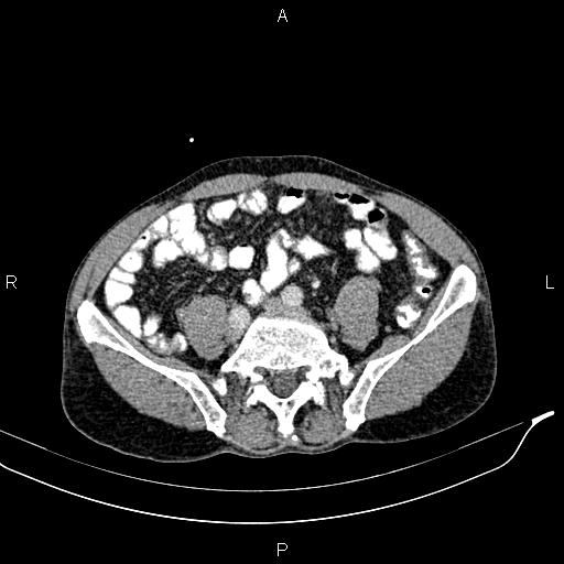 Caput medusae sign - portal hypertension (Radiopaedia 64007-72759 A 67).jpg