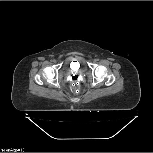 Carcinoma cervix- brachytherapy applicator (Radiopaedia 33135-34173 Axial non-contrast 35).jpg