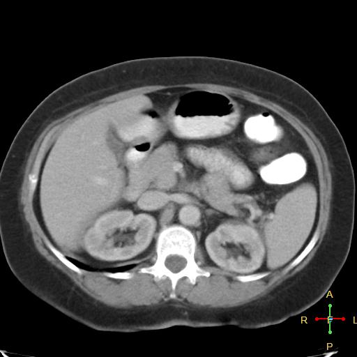 File:Carcinoma of sigmoid colon (Radiopaedia 23071-23100 B 7).jpg