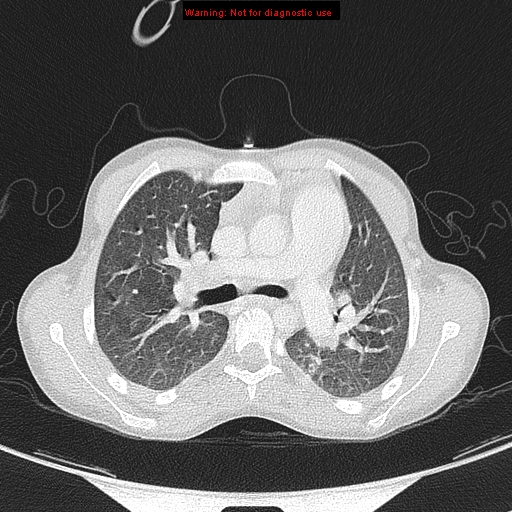 File:Cardiac bronchus (Radiopaedia 14059-13899 A 10).jpg