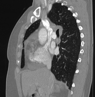Cardiac sarcoidosis (Radiopaedia 74548-85534 Sagittal lung window 55).jpg