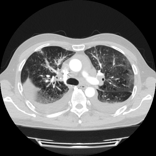 Cardiac tamponade (Radiopaedia 78607-91368 Axial lung window 28).jpg