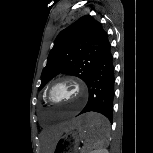 Cardiac tumor - undifferentiated pleomorphic sarcoma (Radiopaedia 45844-50134 B 14).png