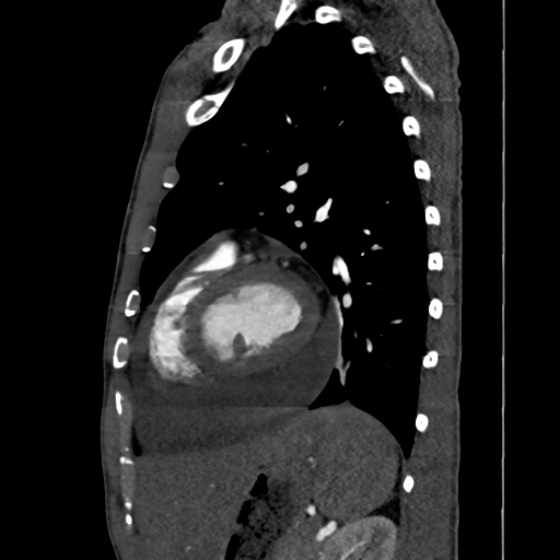 Cardiac tumor - undifferentiated pleomorphic sarcoma (Radiopaedia 45844-50134 B 22).png
