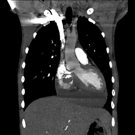 Cardiac tumor - undifferentiated pleomorphic sarcoma (Radiopaedia 45844-50134 Coronal non-contrast 24).png