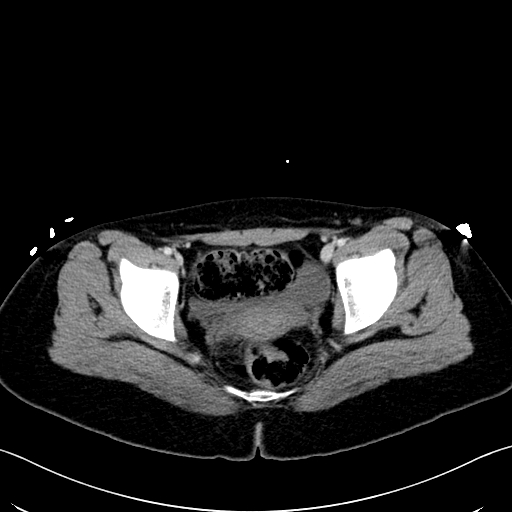 File:Caroli disease with medullary sponge kidney (Radiopaedia 82622-96804 C 70).jpg