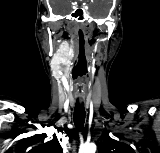 File:Carotid body tumor (Radiopaedia 83615-98727 B 61).jpg