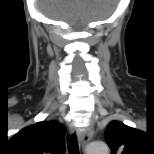File:Carotid body tumor (paraganglioma) (Radiopaedia 38586-40729 B 30).jpg