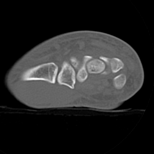 File:Carpo-metacarpal fracture-dislocations with hamatum split fracture (Radiopaedia 18482-18343 Axial bone window 23).jpg