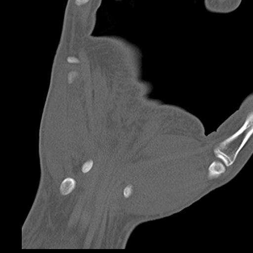 File:Carpo-metacarpal fracture-dislocations with hamatum split fracture (Radiopaedia 18482-18343 Coronal bone window 18).jpg