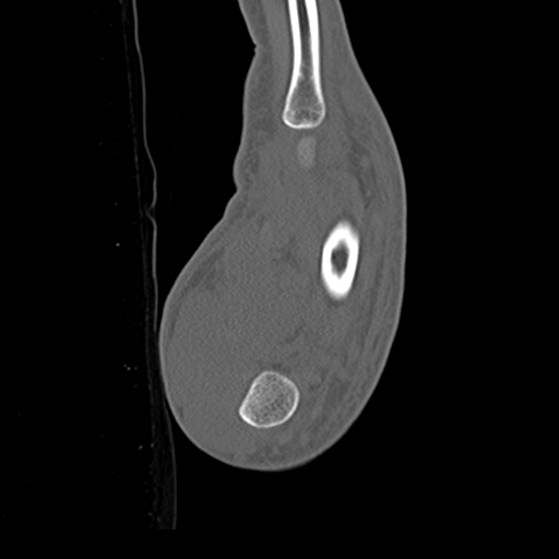 File:Carpo-metacarpal fracture-dislocations with hamatum split fracture (Radiopaedia 18482-18343 Sagittal bone window 29).jpg