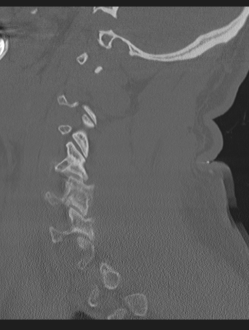 Cavernoma of cervical cord (Radiopaedia 50838-56346 Sagittal bone window 59).png