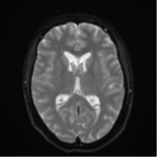 File:Cavernoma with bleed - midbrain (Radiopaedia 54546-60774 Axial DWI 14).png