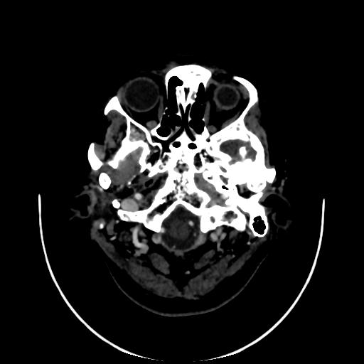 Cavernoma with developmental venous anomaly (Radiopaedia 22470-22506 C 3).jpg