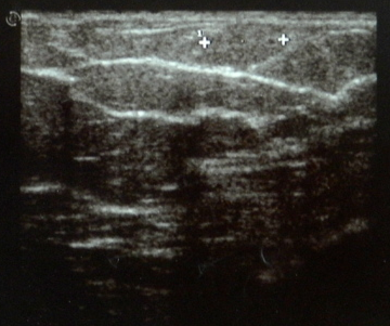 File:Cavernous hemangioma of the breast (Radiopaedia 34615-36003 A 1).png