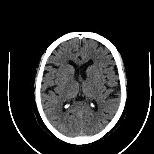 Cavernous hemangioma of the cerebellar falx (Radiopaedia 73025-83723 Axial non-contrast 76).jpg