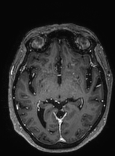 File:Cavernous hemangioma of the cerebellar falx (Radiopaedia 73025-83724 Axial T1 C+ 185).jpg
