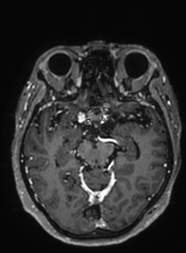 Cavernous hemangioma of the cerebellar falx (Radiopaedia 73025-83724 Axial T1 C+ 203).jpg
