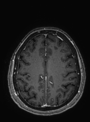 Cavernous hemangioma of the cerebellar falx (Radiopaedia 73025-83724 Axial T1 C+ 97).jpg