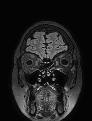 Cavernous hemangioma of the cerebellar falx (Radiopaedia 73025-83724 Coronal FLAIR 45).jpg