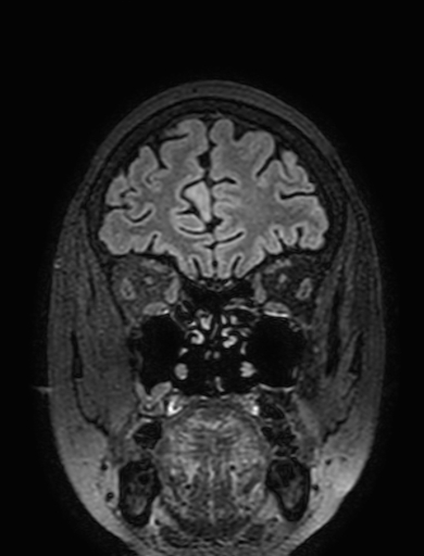 Cavernous hemangioma of the cerebellar falx (Radiopaedia 73025-83724 Coronal FLAIR 63).jpg