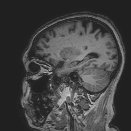 File:Cavernous hemangioma of the cerebellar falx (Radiopaedia 73025-83724 Sagittal T1 67).jpg