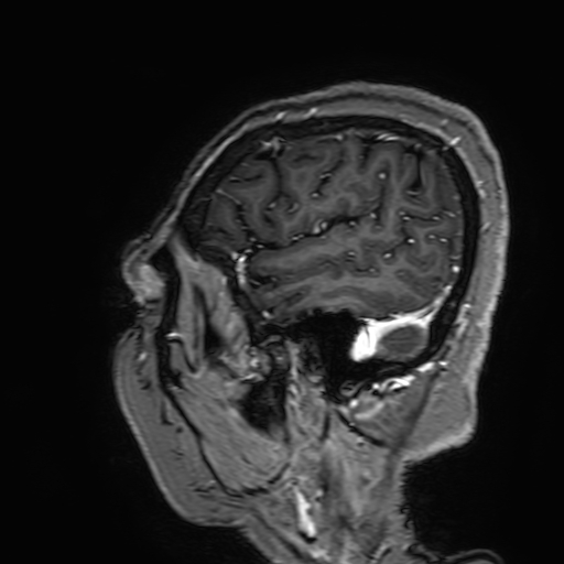 Cavernous hemangioma of the cerebellar falx (Radiopaedia 73025-83724 Sagittal T1 C+ 179).jpg