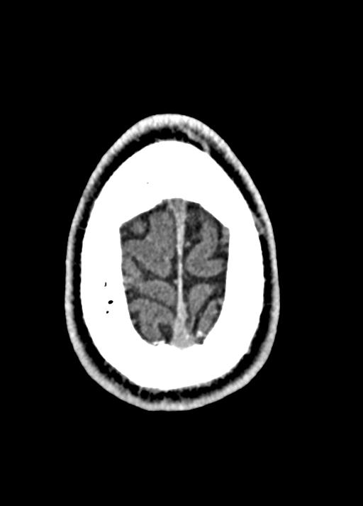 Cavum septum pellucidum and cavum vergae (Radiopaedia 77797-90060 Axial Brain Window 97).jpg
