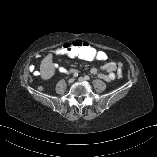 Cecal adenocarcinoma - surgical scar recurrence (Radiopaedia 79988-93264 C 45).jpg