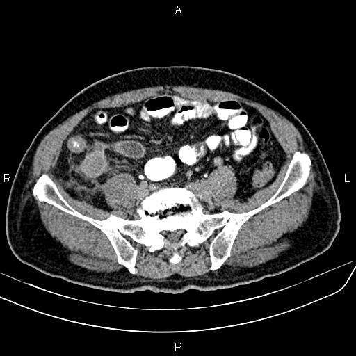 File:Cecal cancer with appendiceal mucocele (Radiopaedia 91080-108651 Axial C+ delayed 55).jpg