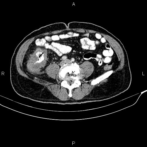 File:Cecal cancer with appendiceal mucocele (Radiopaedia 91080-108651 B 68).jpg