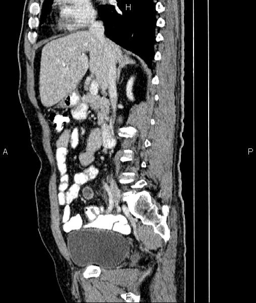 File:Cecal cancer with appendiceal mucocele (Radiopaedia 91080-108651 E 40).jpg