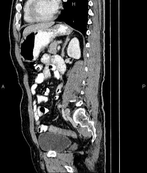 File:Cecal cancer with appendiceal mucocele (Radiopaedia 91080-108651 E 61).jpg