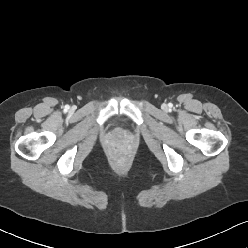 Cecal internal hernia through the foramen of Winslow (Radiopaedia 44820-48651 B 79).png