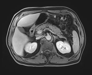Cecal mass causing appendicitis (Radiopaedia 59207-66532 J 48).jpg
