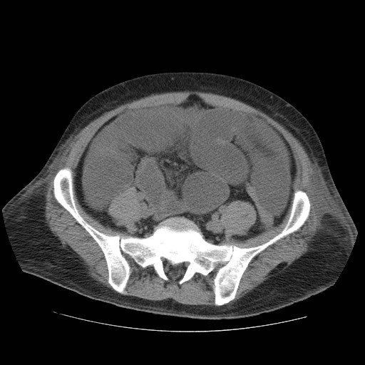 Cecal volvulus (Radiopaedia 28294-28534 Axial non-contrast 72).jpg