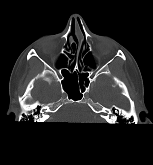 Cemento-ossifying fibroma (Radiopaedia 46243-50643 Axial bone window 21).png