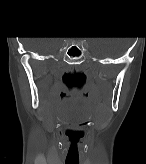 Cemento-ossifying fibroma (Radiopaedia 46243-50643 Coronal bone window 35).png