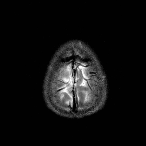 File:Central-variant posterior reversible encephalopathy syndrome (PRES) (Radiopaedia 43880-47359 Axial T2 23).jpg