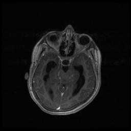 Central neurocytoma (Radiopaedia 30220-30842 Axial T1 C+ 56).jpg