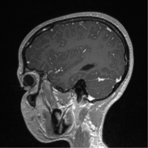 Central neurocytoma (Radiopaedia 37664-39557 Sagittal T1 C+ 72).png