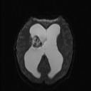 Central neurocytoma (Radiopaedia 56690-63469 Axial DWI 11).jpg