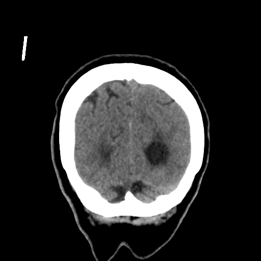 Central neurocytoma (Radiopaedia 65317-74346 Coronal non-contrast 53).png