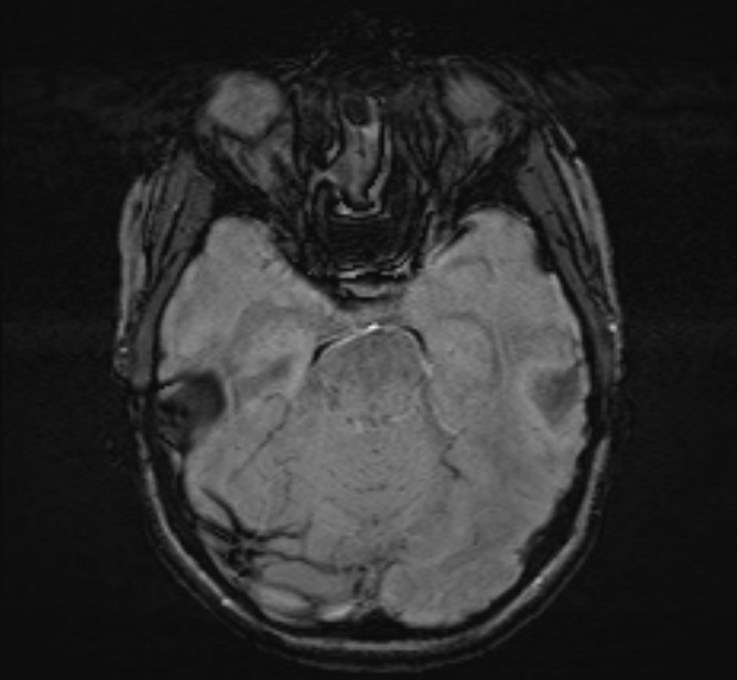 Central neurocytoma (Radiopaedia 70263-80336 Axial SWI 19).jpg