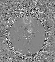 Central neurocytoma (Radiopaedia 84497-99872 Axial 33).jpg