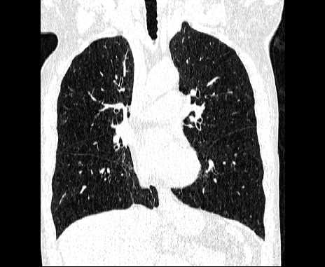 Centrilobular pulmonary emphysema (Radiopaedia 62468-70718 Coronal lung window 34).jpg